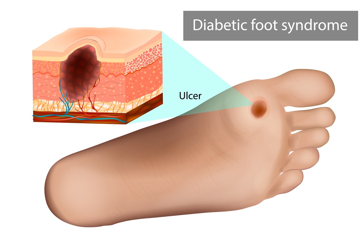 Tvrdý kožný vred na nohe (diabetes mellitus)